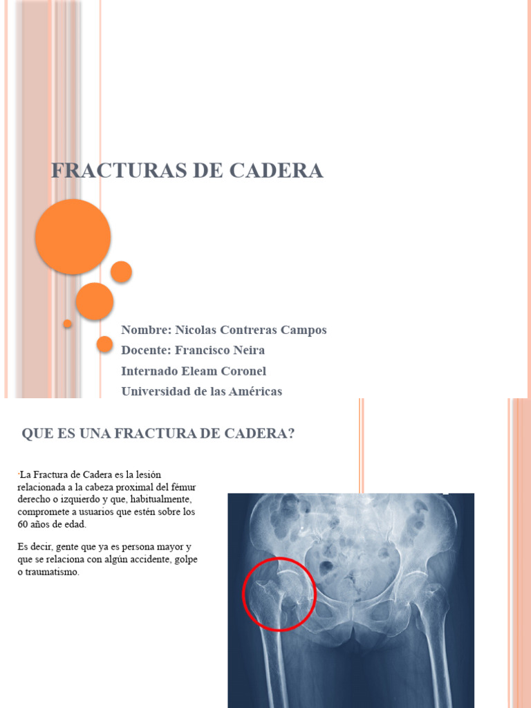 Fractura de Cadera | PDF