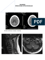 Imagenes Malformacion Intracr