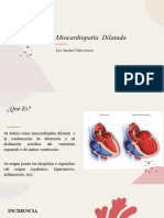 Miocardiopatía Dilatada