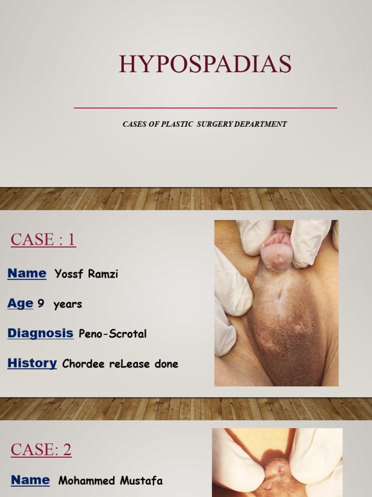 PPT - Hypospadias PowerPoint Presentation, free download - ID:9136397, image size:768x1024