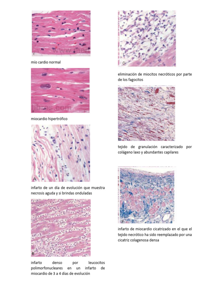 Cardio Micro | Descargar gratis PDF | Inflamación | Infarto de miocardio