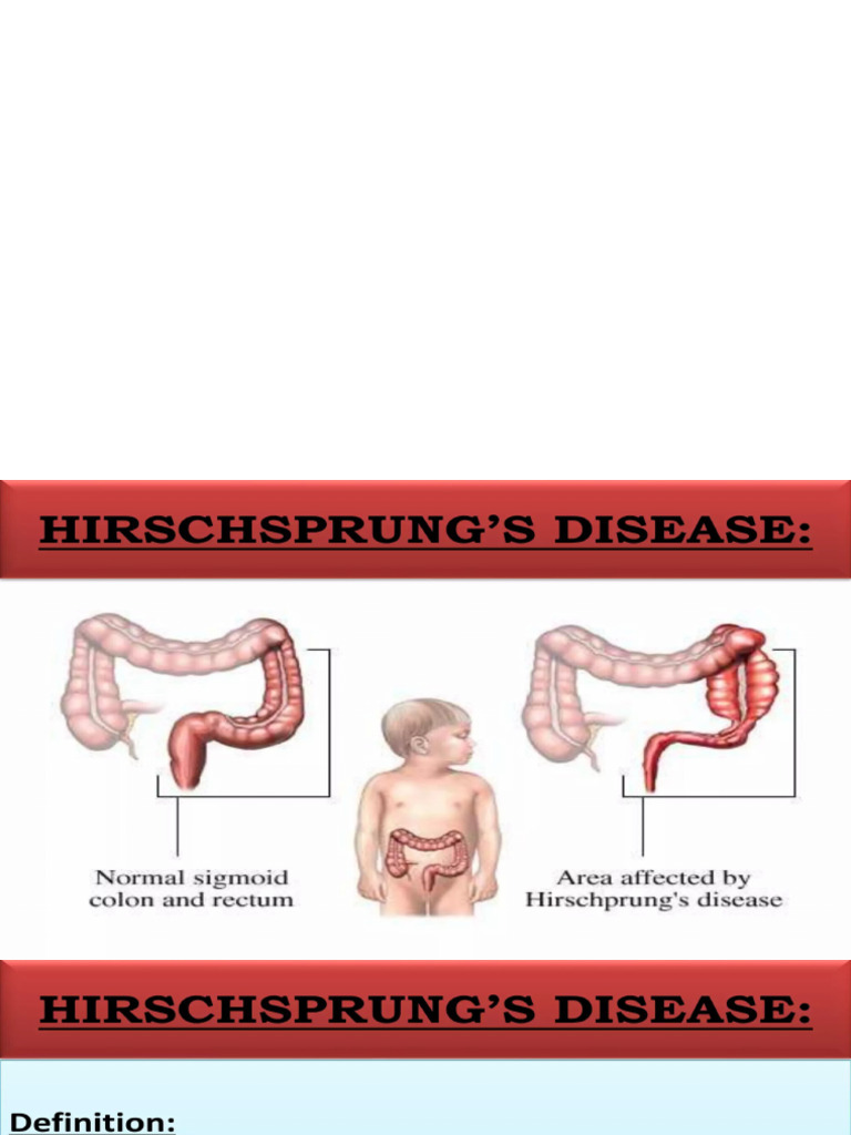 Hirschsprung Disease PDF
