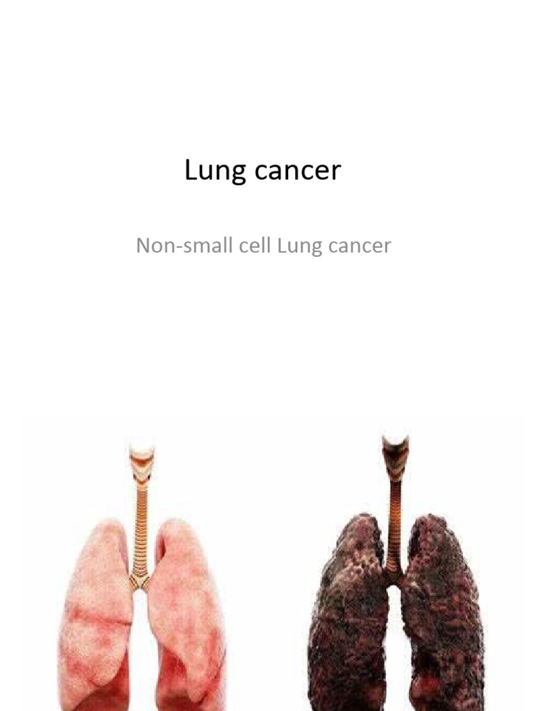Stage 3 Non-Small Cell Lung Cancer Case | PDF | Lung Cancer | Cancer