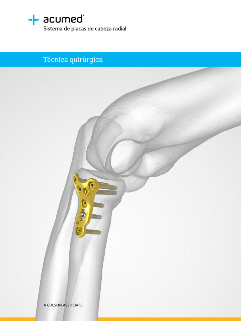 Acumed Surgical Technique ES Locking Radial Head Plates ESELB00 02 A ...