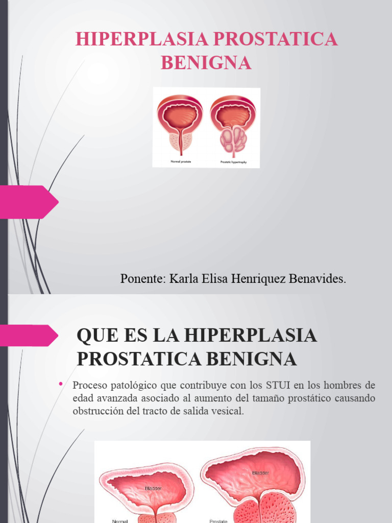 Hiperplasia Prostática: Diagnóstico y Tratamiento | PDF