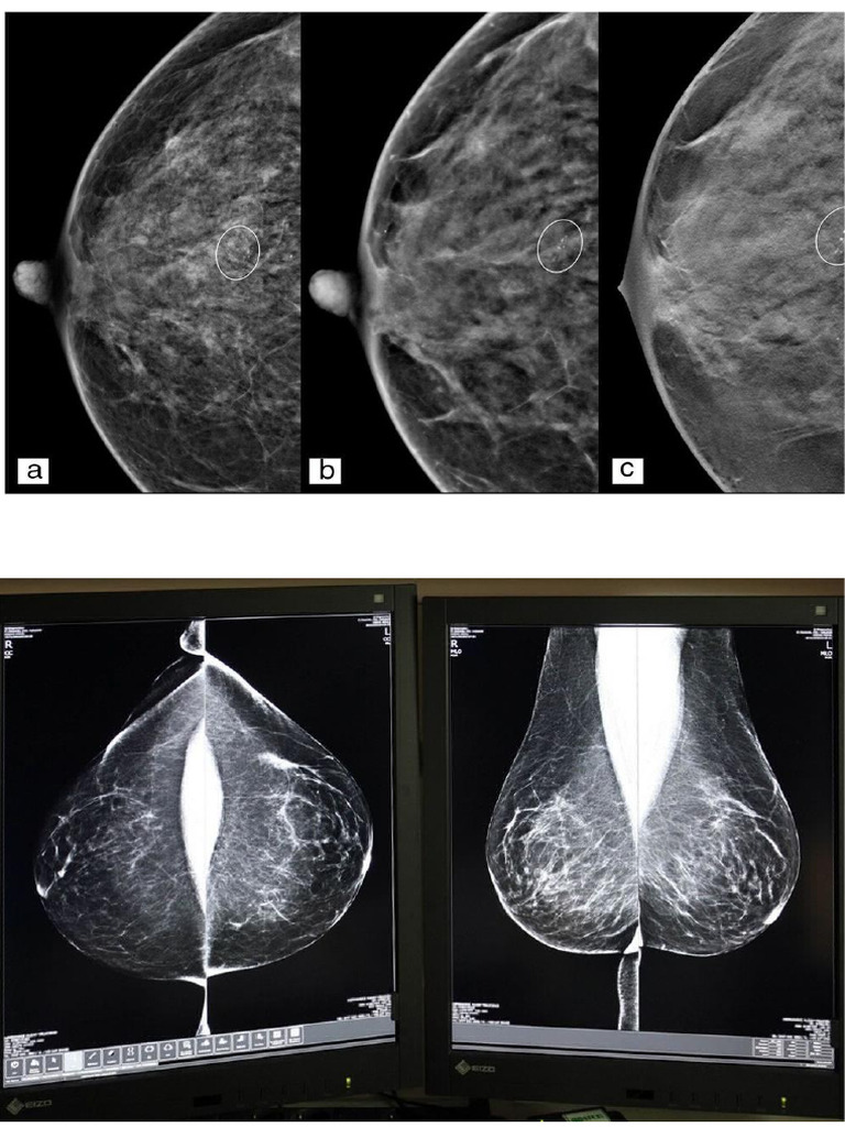 Imágenes Mamografia | PDF
