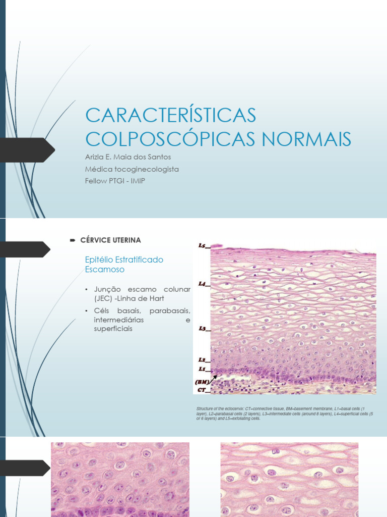 Achados Colposcópicos Normais | PDF | Epitélio | Especialidades médicas