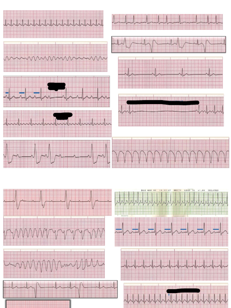 ECG Pics Practice | PDF