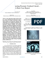 A Giant Obstructing Prostatic Urethral Calculi - A Rare Case Report