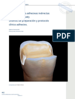 Posterior_indirect_adhesive_restorations.en.es