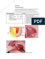 Tecnicas de Anestesia Mandibular