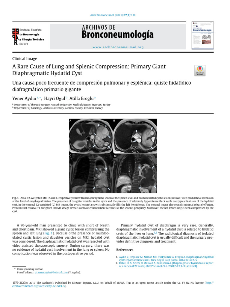 A Rare Cause of Lung and Splenic Compression - 2021 - Archivos de ...