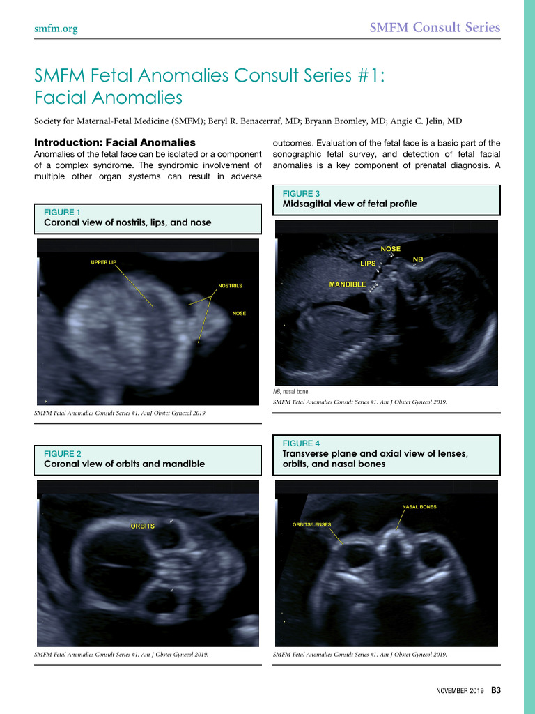 SMFM Facial Anomalies | PDF | Down Syndrome | Genetics