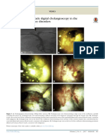 Percutaneous Antegrade Digital Cholangioscopy in T