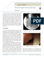 Lumen Apposing Metal Stent For Gastric Stricture A