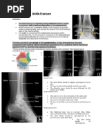 Ankle Fracture