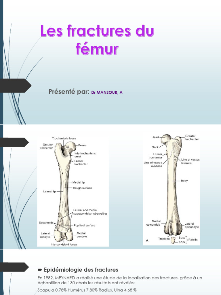 Fractures du fémur : Types et traitements | PDF | Appareil locomoteur ...