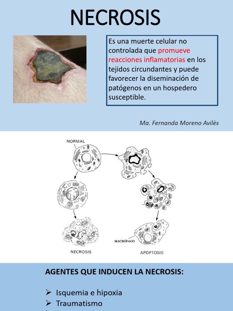 Tipos y características de necrosis | PDF | Biología Celular) | Inflamación