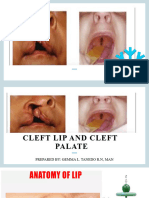 Cleft Lip and Palate