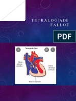 Tetralogía de Fallot