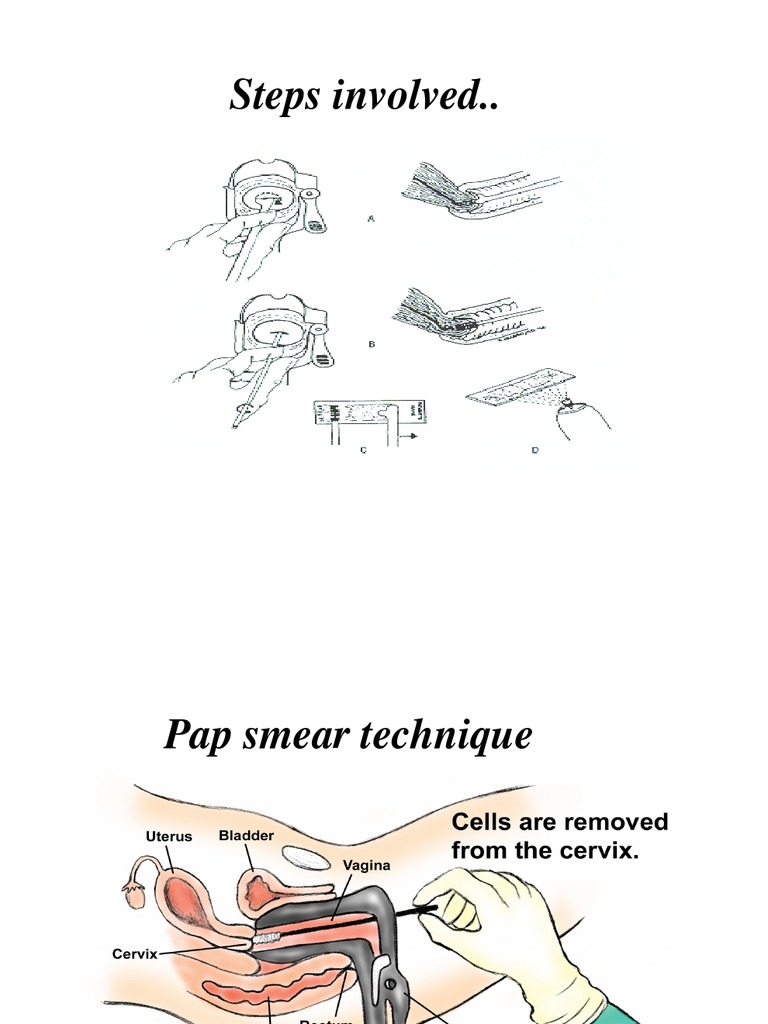 Pap Smear Technique Picture