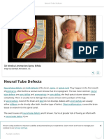 Neural Tube Defects - StoryMD