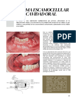 Carcinoma Escamocelular de Cavidad Oral