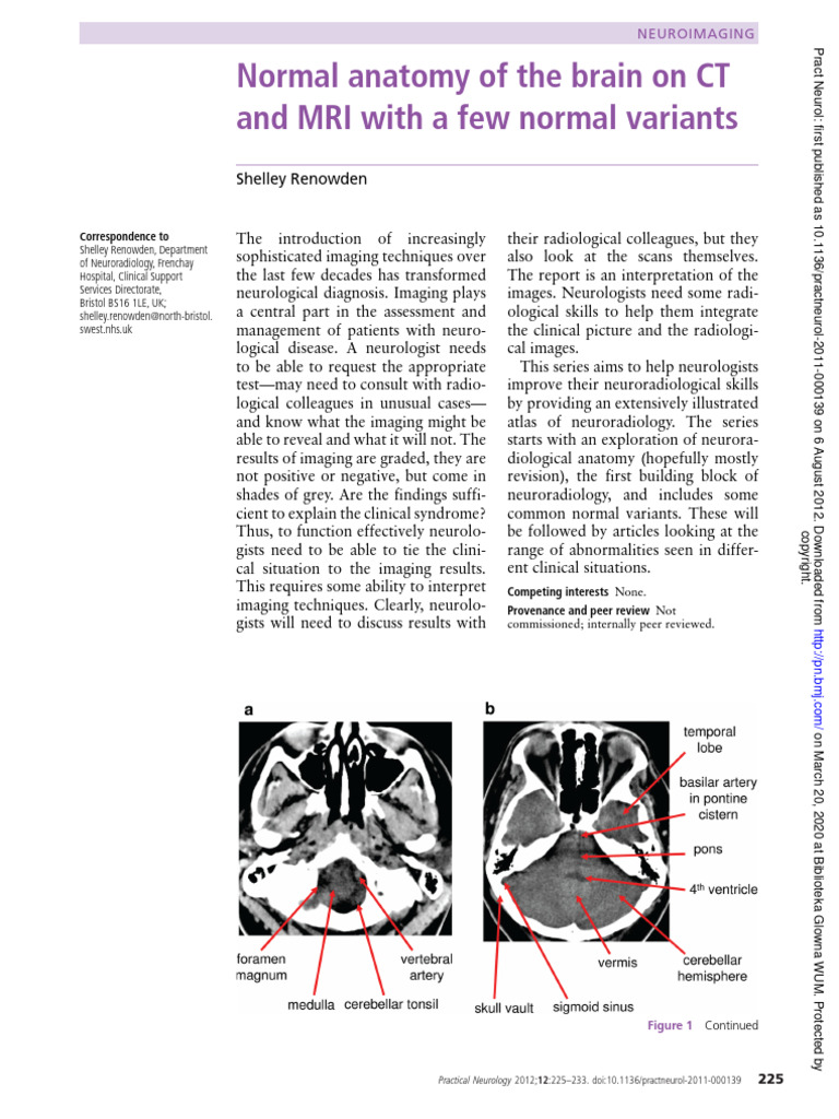 Normal Anatomy of the Brain on CT and MRI With a Few Normal Variants