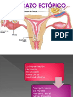 Emb Ectopico Arreglado
