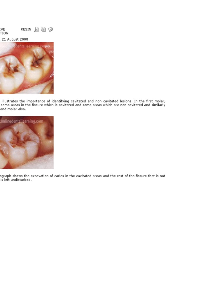 Preventive Resin Restoration PDF