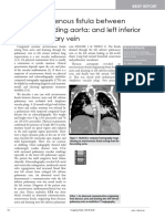 Arteriovenous Fistula Between Descending Aorta and Left Inferior Pulmonary Vein