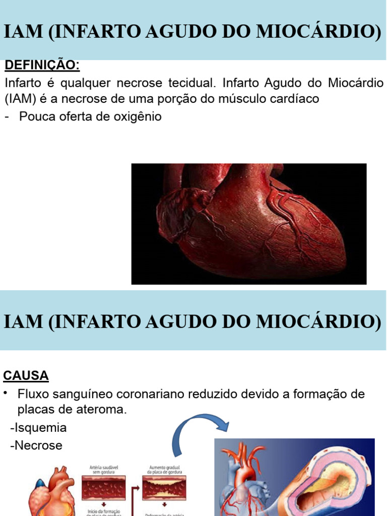 Causas e Tratamento do IAM | PDF | AVC | Infarto do Miocárdio