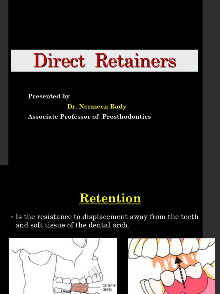 Understanding Direct Retainers in RPDs | PDF | Stiffness | Bending