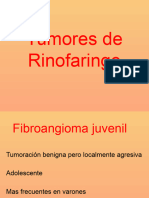 Tumores de Rinofaringe