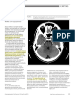 PT-BR (2013) Increased Sensitivity To Atypical Antipsychotics in A Patient With Dandy-Walker Variant With Schizophrenia - En.pt