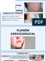 Flemon Cervico Facial, Angina de Ludwig y Angina de Vincent