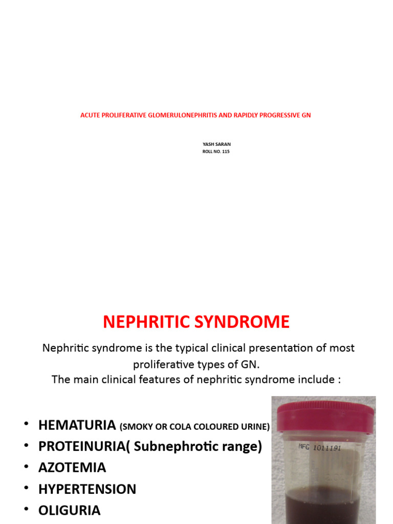 Acute Proliferative Glomerulonephritis Overview | PDF | Medical ...
