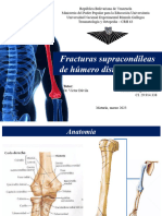 FX Supracondileas de Humero Distal. Ariana