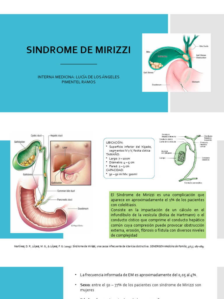 Síndrome de Mirizzi: Diagnóstico y Tratamiento | PDF | Vesícula biliar ...