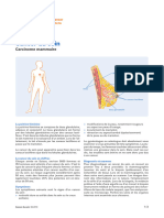 Cancer Du Sein Carcinome Mammaire