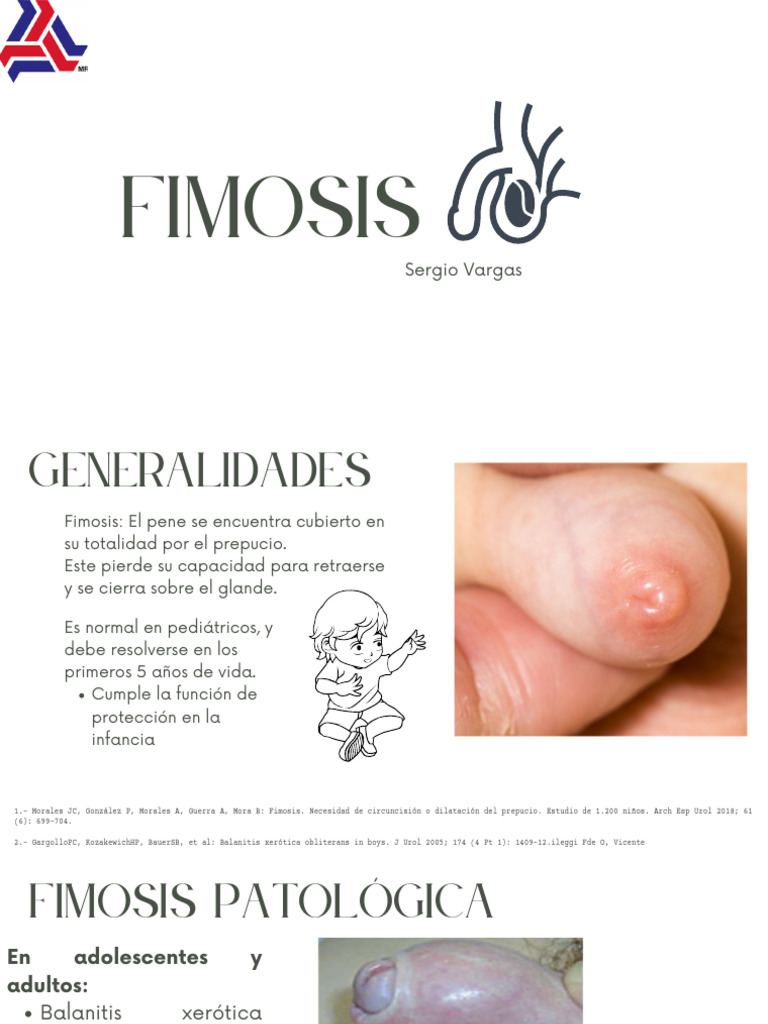 Fimosis y Balanitis en Niños | PDF | Sistema genitourinario | Urología