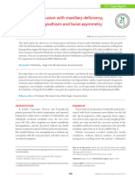 Class III Malocclusion With Maxillary Deficiency, Mandibular Prognathism and Facial Asymmetry Almeida2016