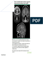 MRI of CIS Presenting As Optic Neuritis