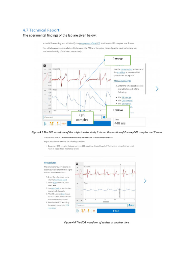 ECG Waveform Analysis Report | PDF