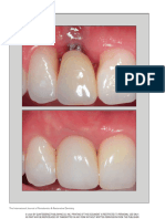 Stefanini2020 Periimplant Papillae Reconstruction