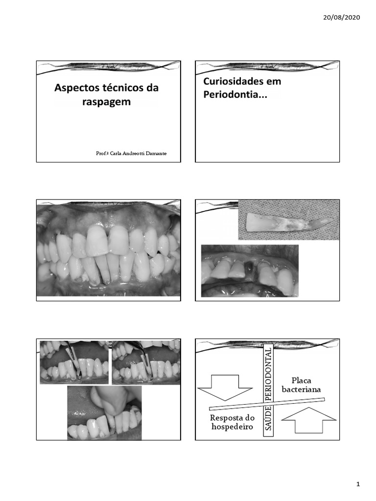 Raspagem Radicular em Dentes Calcificados | PDF | Dente humano | Boca