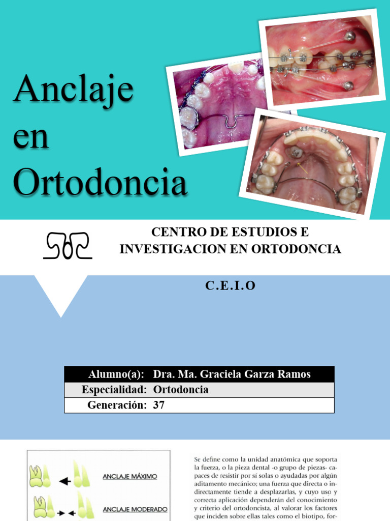 ANCLAJE | PDF | Ortodoncia | Fuerza