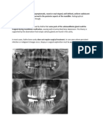 Stafne's Bone Cyst (SBC)