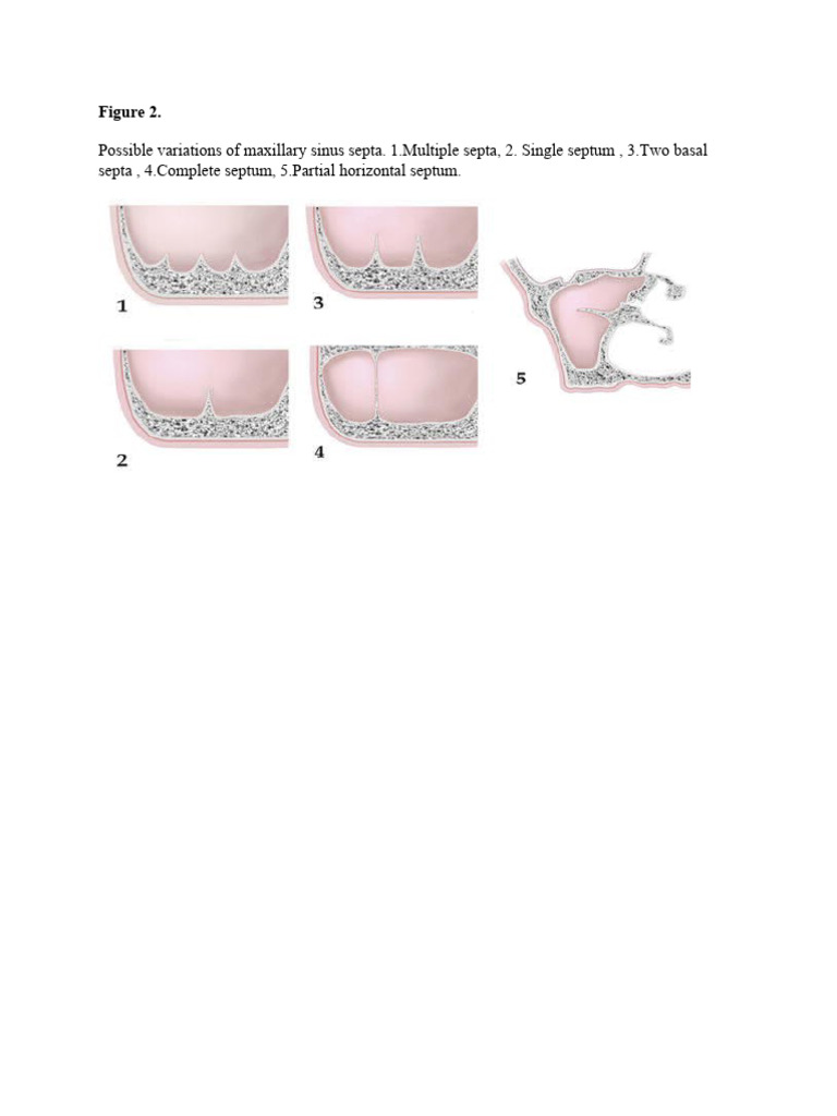 maxillary-sinus-septa-pdf