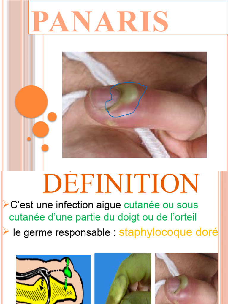 Comprendre le panaris : symptômes et traitements | PDF